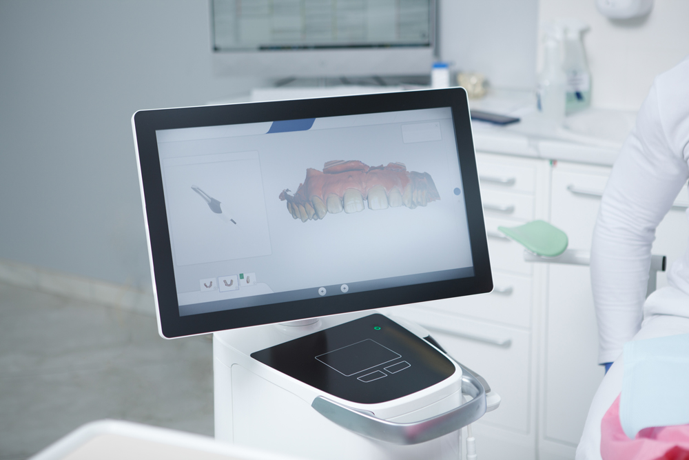 Intraoralscanner - CEREC setzt einen digitalen Scan Ihrer Zähne voraus